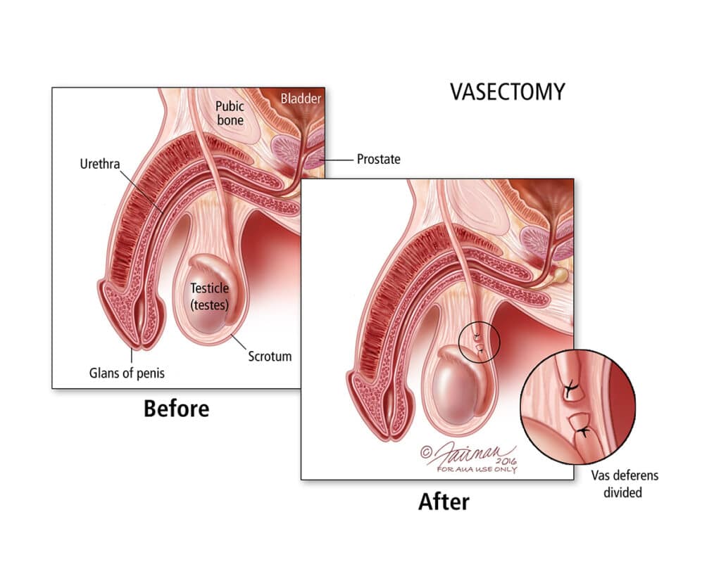 My Hubby Did Vasectomy, The Truth And What You Need To Know 1