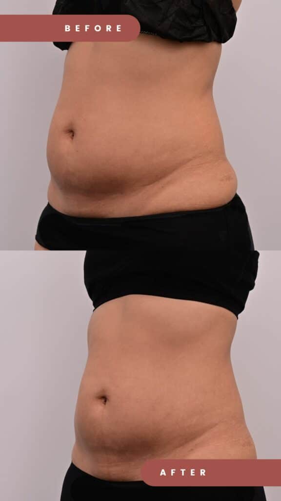 I Tried Coolsculpting At Halley Medical Aesthetics and Here's The Results. 12