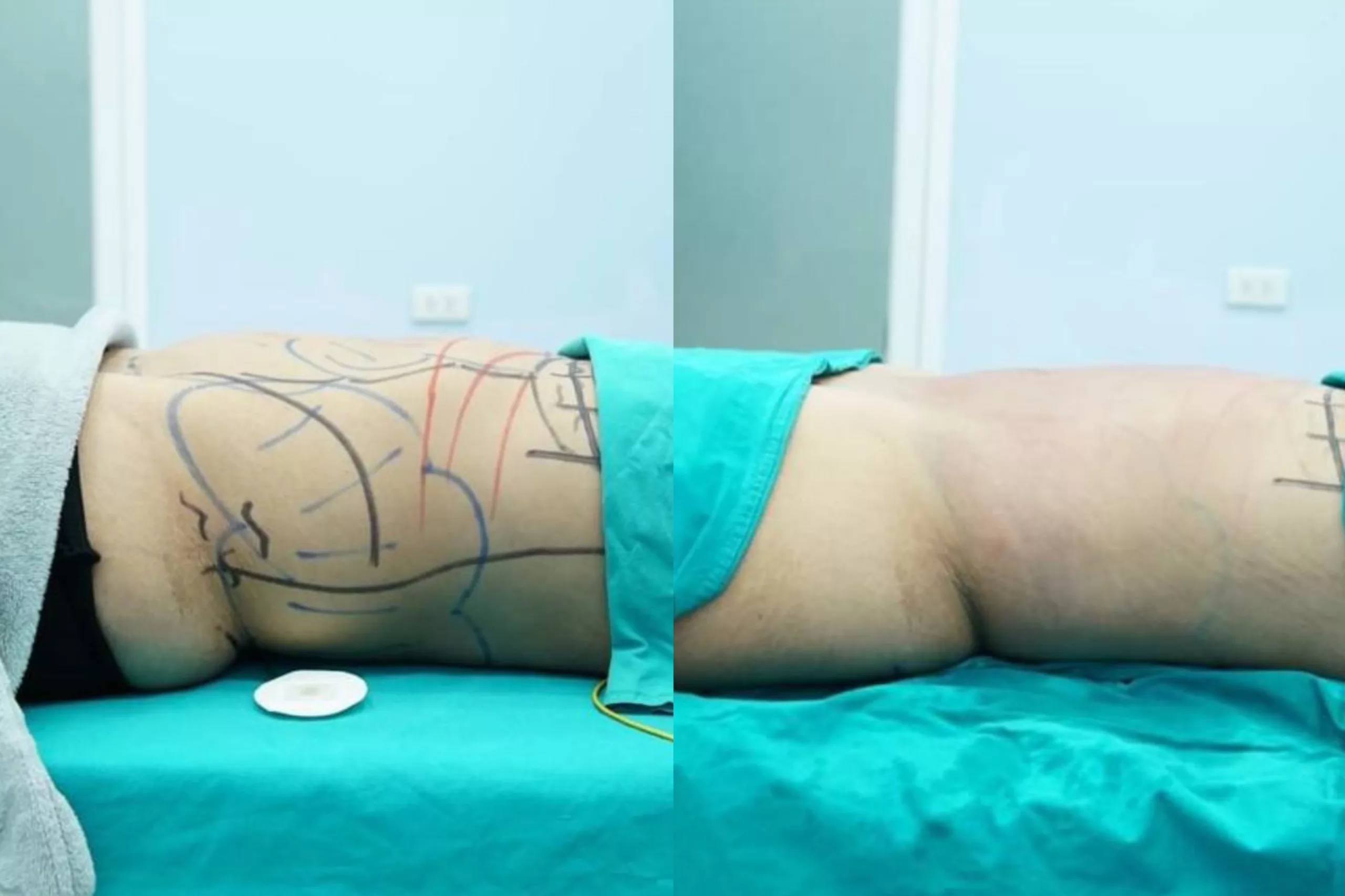 Post tummy liposuction and J Plasma.