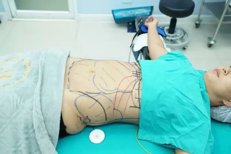 breast augmentation and liposuction surgery in Bangkok