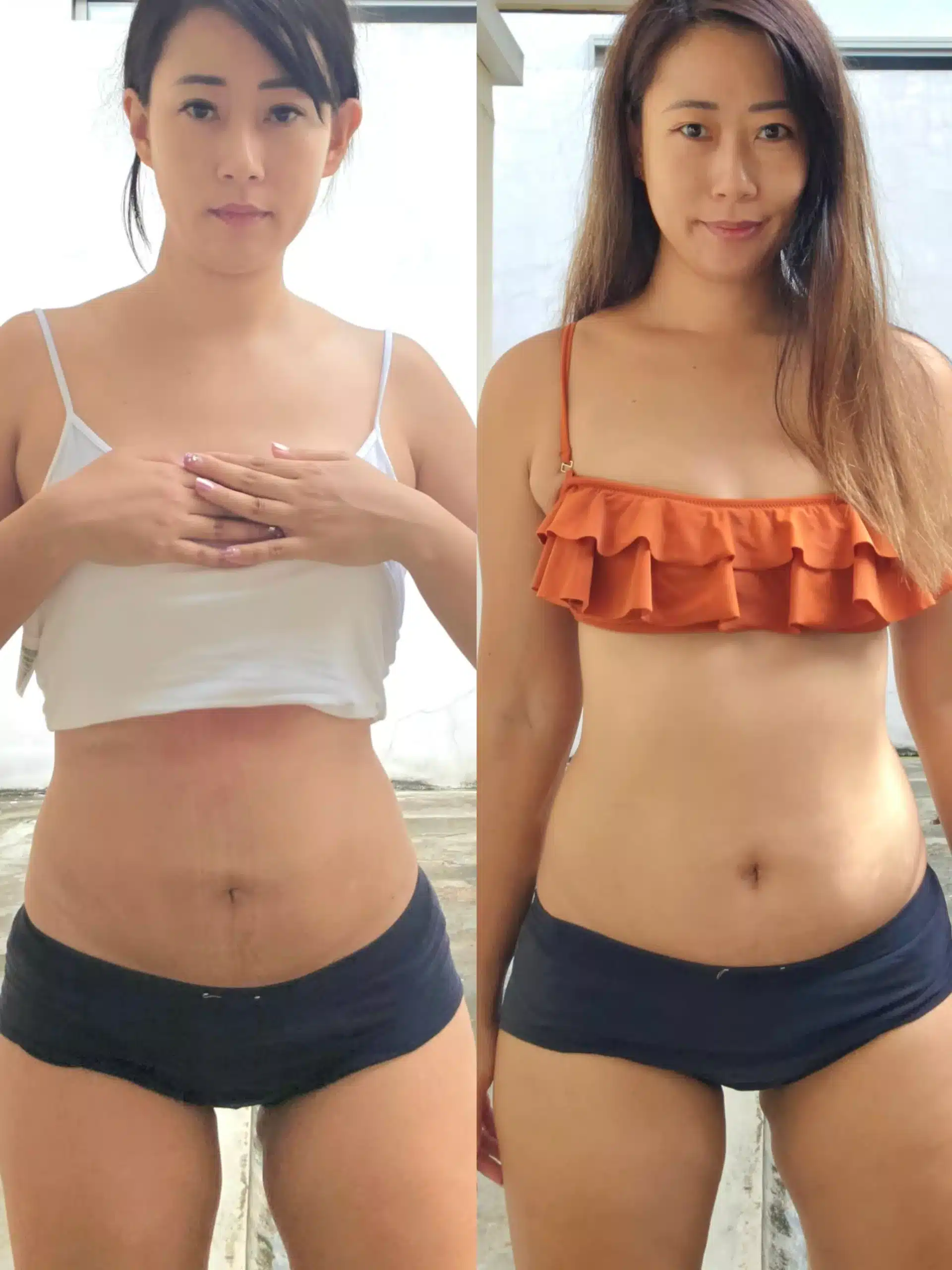 post liposuction