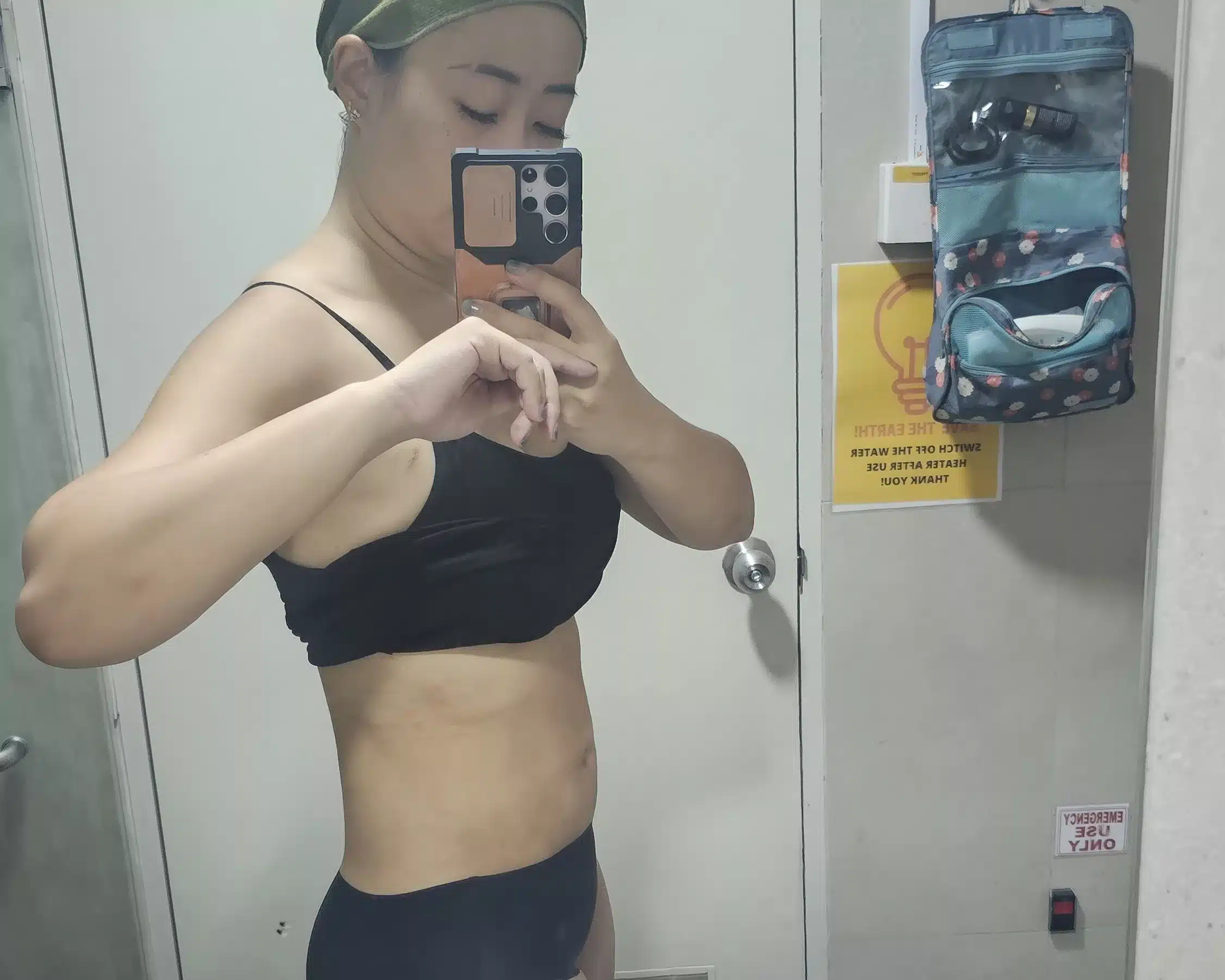 Tummy Liposuction, J Plasma and Breast Augmentation At BKK - Results and Recovery 10
